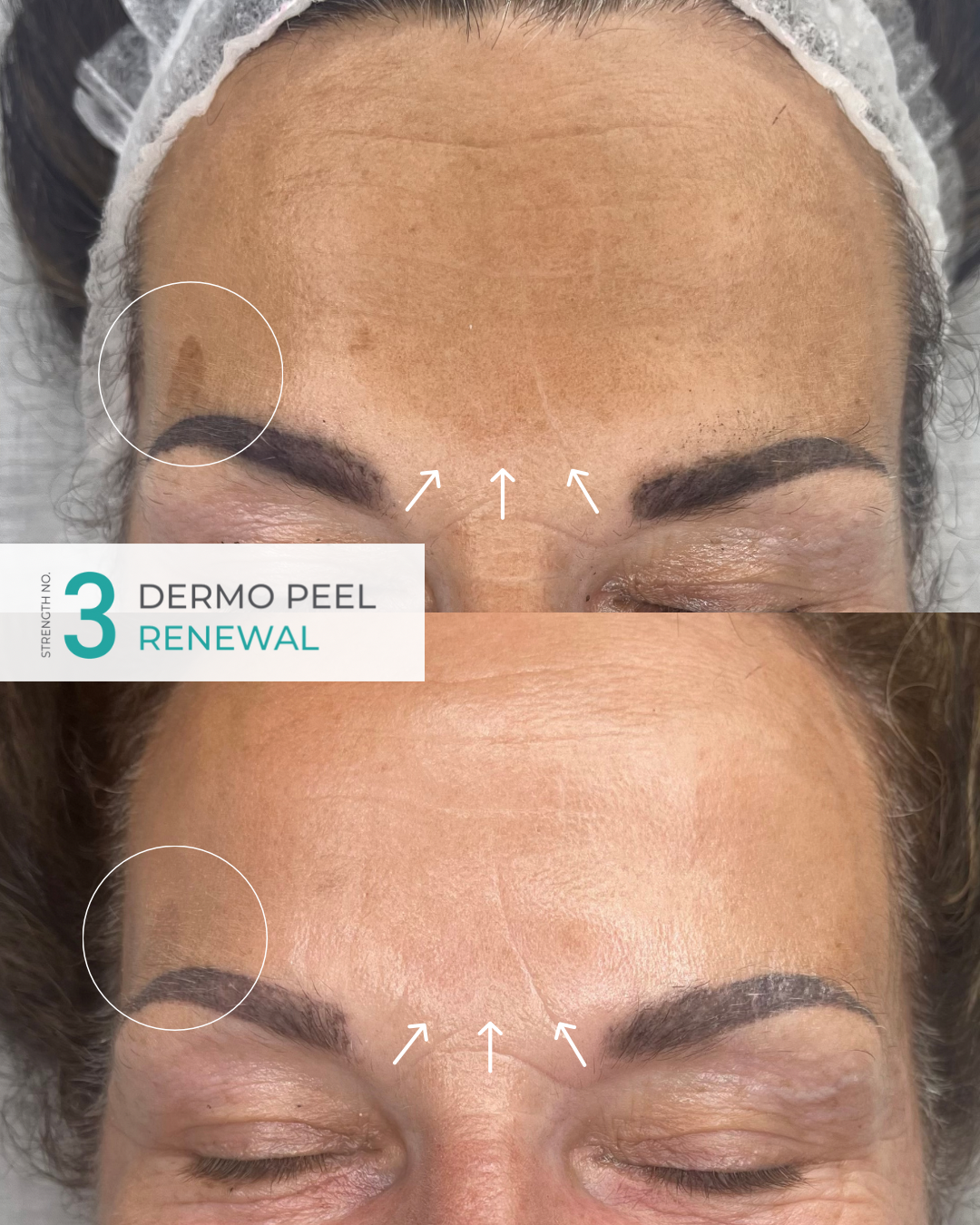 Dermo PeelResult